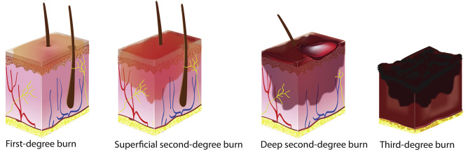HBOT For Thermal/ Extensive Burns in Aurangabad